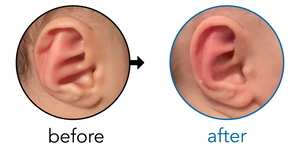 Before-and-after EarBuddies Rim Kink result; started at 1–3 months – Melissa & her daughter