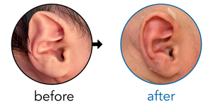 Before-and-after EarBuddies Stahl's Bar result; started within the first month – Keith Leung (Orthotist) & Baby Z