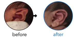 Before-and-after EarBuddies Stahl's Bar result; started within the first month – Leopoldo & his Daughter