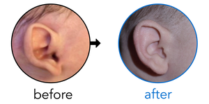 Before-and-after EarBuddies Stick-Out Ears result; started at 1–3 months – Pilar, Lars & their Son Laureano