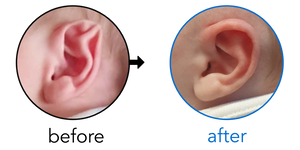 Before-and-after EarBuddies Stahl's Bar result; started at 1–3 months – Michelle & her son Tommy