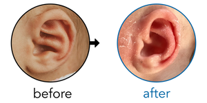 Before-and-after EarBuddies Conchal Crus result; started within the first month – Jada & her son
