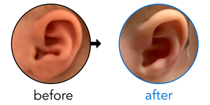 Before-and-after EarBuddies Conchal Crus result; started at 1–3 months – Talia & her daughter Millie