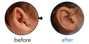 Before-and-after EarBuddies Stick-Out Ears result; started at 3–6 months – Keri & her Daughter