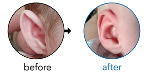 Before-and-after EarBuddies Stick-Out Ears result; started at 1–3 months – Karen & her daughter Charlotte