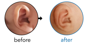 Before-and-after EarBuddies Stick-Out Ears result; started at 1–3 months – Nada & her son