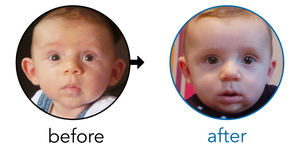 Before-and-after EarBuddies Stick-Out Ears result; started at 1–3 months – Ruth & her son Clark