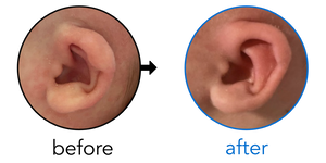 Before-and-after EarBuddies Lop Ear result; started at 1–3 months – Chandler & her Daughter