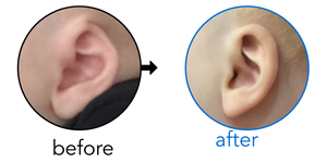Before-and-after EarBuddies Cryptotia result; started at 3–6 months – Hadley, Josh & their son Boden