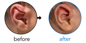 Before-and-after EarBuddies Lop Ear result; started at 1–3 months – Sara & her son