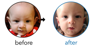 Before-and-after EarBuddies Stick-Out Ears result; started at 1–3 months – Mr. Lopez & his son