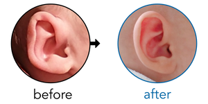 Before-and-after EarBuddies Folded-Over Helical Rim result; started within the first month – Dora & her daughter