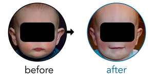 Before-and-after EarBuddies Stick-Out Ears result; started at 6–12 months – Dr. Kristen H. & her Baby Son