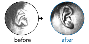 Before-and-after EarBuddies Stick-Out Lobe result; started at 1–3 months – Mrs J. & her son Howard