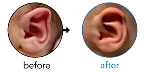 Before-and-after EarBuddies Stahl's Bar result; started within the first month – Laura & her daughter