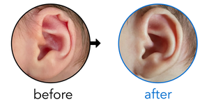 Before-and-after EarBuddies Rim Kink result; started within the first month – Stacy & her son Mason
