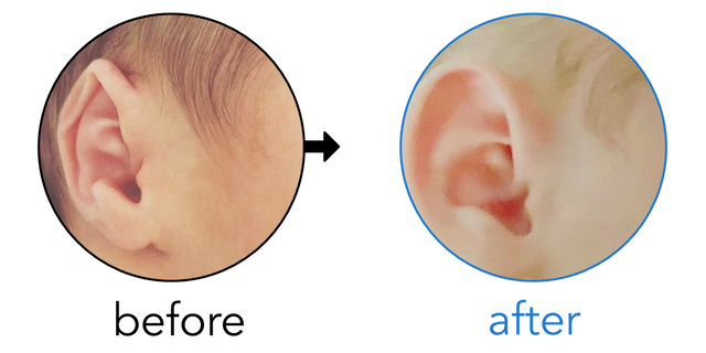 Before-and-after EarBuddies Folded-Over Helical Rim result; started within the first month – Jen Cavy