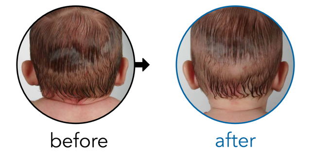 Before-and-after EarBuddies Stick-Out Ears result; started at 1–3 months – Mrs. D & her Daughter