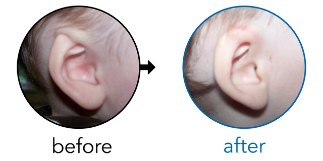 Before-and-after EarBuddies Cryptotia result; started at 6–12 months – Stephanie & her Son