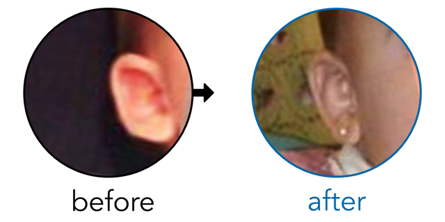 Before-and-after EarBuddies Stick-Out Ears result; started at 1–3 months – Mrs. Perez & her Daughter