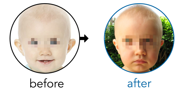 Before-and-after EarBuddies Stick-Out Ears result; started at 12–18 months – Mrs Tam J & her Daughter