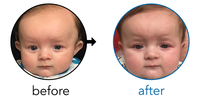 Before-and-after EarBuddies Stick-Out Ears result; started at 3–6 months – Paige & her Son Noah