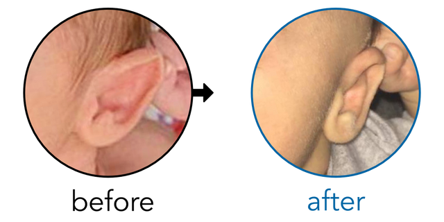 Before-and-after EarBuddies Stick-Out Ears result; started at 1–3 months – Mrs. Kasey O. & her Son