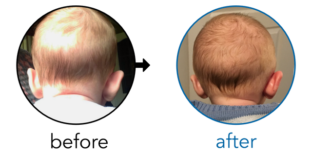Before-and-after EarBuddies Stick-Out Ears result; started at 1–3 months – Mrs K.W & her Son Harry