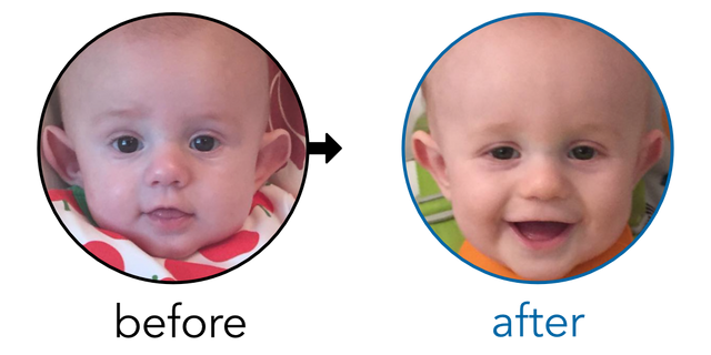 Before-and-after EarBuddies Stick-Out Ears result; started at 3–6 months – Michelle, Stuart & their Son Louis