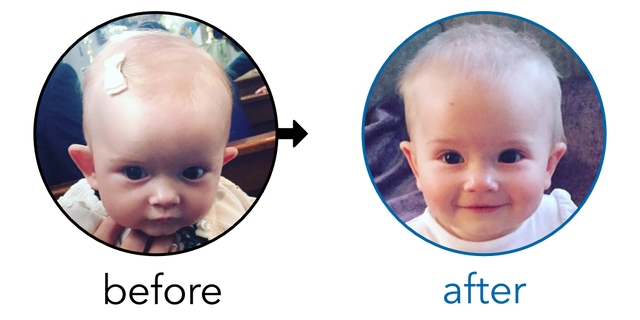 Before-and-after EarBuddies Stick-Out Ears result; started at 3–6 months – Laura & her Baby Daughter