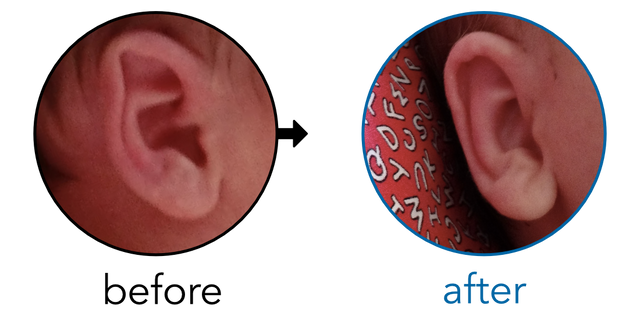 Before-and-after EarBuddies Folded-Over Helical Rim result; started within the first month – Mrs. B & her Baby Son