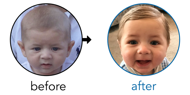 Before-and-after EarBuddies Stick-Out Ears result; started at 3–6 months – Danielle & her Son Jesse