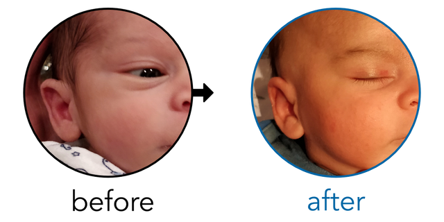 Before-and-after EarBuddies Stick-Out Ears result; started within the first month – David & his Son