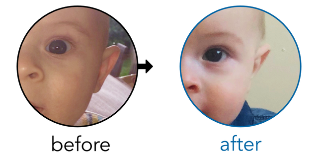 Before-and-after EarBuddies Stick-Out Ears result; started at 1–3 months – Amanda & her Son Harry
