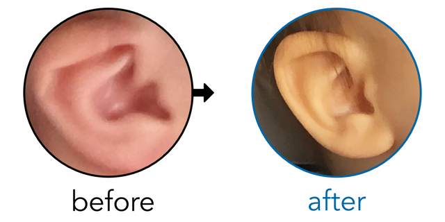 Before-and-after EarBuddies Lop Ear result; started within the first month – Jacquelyn & her Daughter Avery