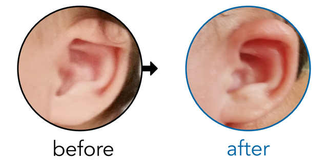 Before-and-after EarBuddies Lop Ear result; started at 1–3 months – Samantha & her Daughter Carter