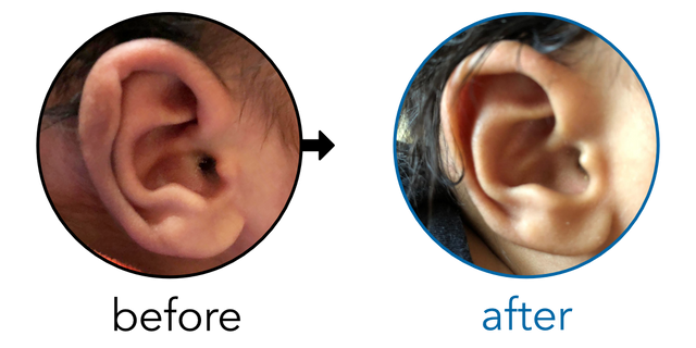 Before-and-after EarBuddies Folded-Over Helical Rim result; started within the first month – Gav & his Son Rivi