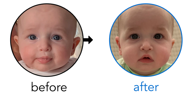 Before-and-after EarBuddies Stick-Out Ears result; started at 3–6 months – Jamie & his son Zachary