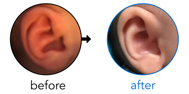 Before-and-after EarBuddies Conchal Crus result; started at 1–3 months – Marlena & her Son
