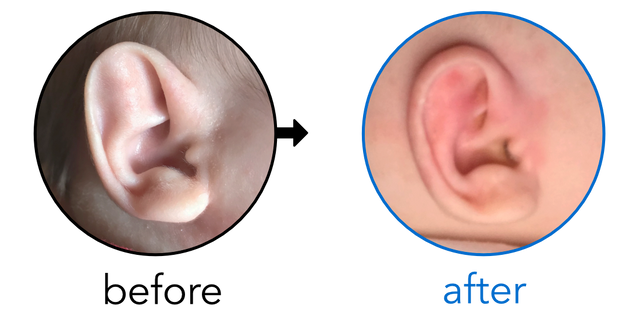 Before-and-after EarBuddies Stahl's Bar result; started at 1–3 months – Amy & her Daughter Everly