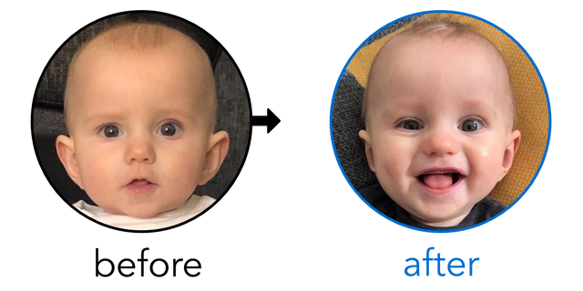 Before-and-after EarBuddies Stick-Out Ears result; started at 6–12 months – @ourearbuddiesjourney