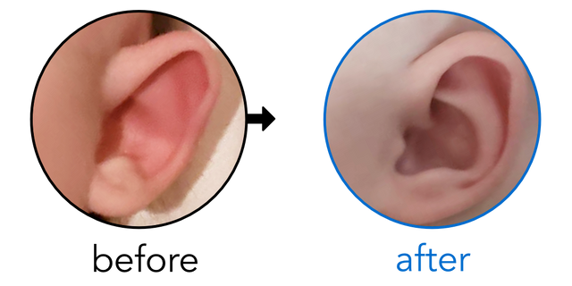 Before-and-after EarBuddies Stick-Out Ears result; started at 3–6 months – Nicole & her daughter Molly