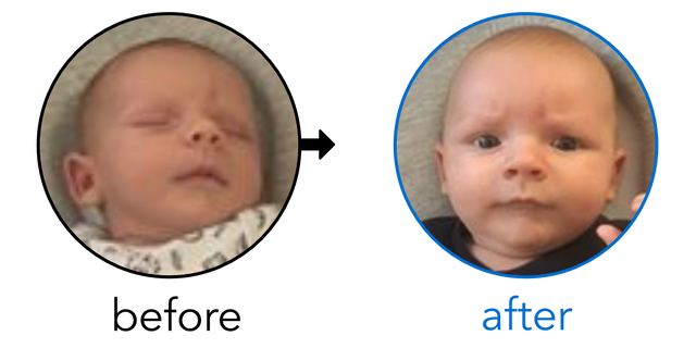 Before-and-after EarBuddies Stick-Out Ears result; started within the first month – James & his Son