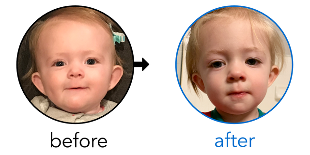 Before-and-after EarBuddies Stick-Out Ears result; started at 6–12 months – Ashley & her Daughter Kira