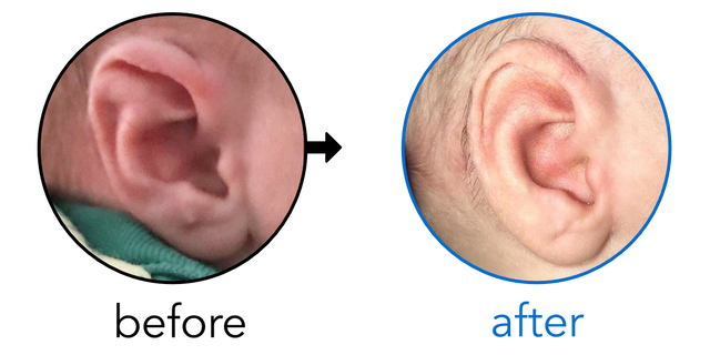 Before-and-after EarBuddies Stahl's Bar result; started within the first month – Toni & her Son Logan