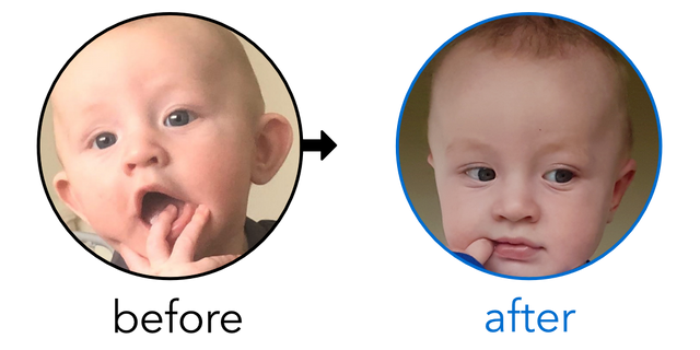 Before-and-after EarBuddies Stick-Out Ears result; started at 3–6 months – Carla & her Son Jude