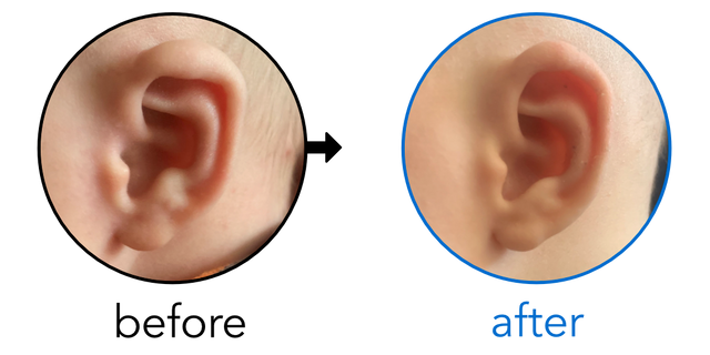 Before-and-after EarBuddies Lop Ear result; started within the first month – Charisse & her Son Björn