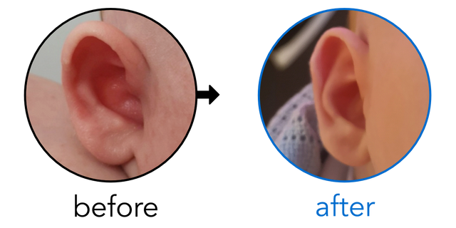 Before-and-after EarBuddies Stick-Out Ears result; started within the first month – Joni & her Son Fletcher