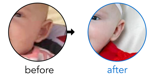 Before-and-after EarBuddies Stick-Out Ears result; started at 3–6 months – Amanda D