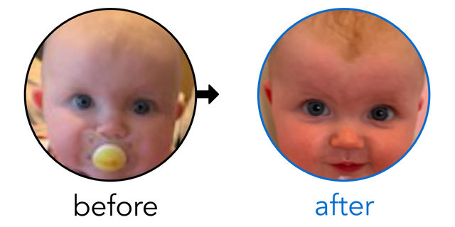 Before-and-after EarBuddies Cup Ear result; started at 1–3 months – Stephanie & her Daughter Ferne